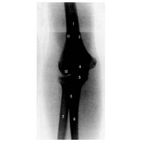 Дистальный эпифиз правой плечевой кости и проксимальные эпифизы правых локтевой и лучевой костей (рентгенограмма)