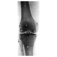 Дистальный эпифиз правой бедренной кости и проксимальные эпифизы правых большеберцовой и малоберцовой костей (рентгенограмма)
