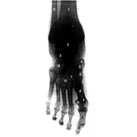 Кости стопы, правой (рентгенограмма)