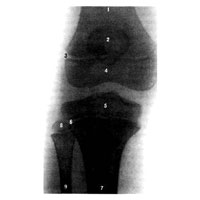 Эпифизарные хрящи (рентгенограмма). (Правый коленный сустав ребенка 12 лет.)