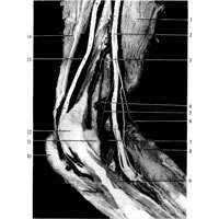 Рис. 1015. Нервы суставной капсулы локтевого сустава, левого; локтевая сторона (фотография. Препарат Е. Страховой). 1 – плечевая мышца; 2 – срединный нерв; 3, 5, 7 – ветви к суставной капсуле локтевого сустава; 4 – ветвь к надкостнице плечевой кости; 6 – нерв к круглому пронатору; 8 – круглый пронатор (отрезан и оттянут); 9 – локтевой сгибатель кисти; 10 – локтевой отросток; 11 – суставная капсула локтевого сустава; 12 – медиальный надмыщелок; 13 – локтевой нерв; 14 – трехглавая мышца плеча.