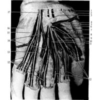 Рис. 1017. Ветви срединного и локтевого нервов ладонной поверхности кисти, левой (фотография. Препарат Л. Киселевой). 1 – срединный нерв; 2 – отводящая мышца большого пальца кисти (оттянута); 3 – поперечная запястная связка; 4 – нерв к отводящей мышце; 5 – нерв к мышце, противопоставляющей большой палец; 6 – мышца, противопоставляющая большой палец кисти; 7 – поверхностная головка короткого сгибателя большого пальца кисти; 8 – нерв от глубокой ветви локтевого нерва входит в глубокую головку короткого сгибателя большого пальца кисти; 9 – нерв к пястно-фаланговому суставу большого пальца кисти; 10 – нерв к первой червеобразной мышце; 11 – нерв ко второй червеобразной мышце; 12 – собственные ладонные пальцевые нервы; 13 – нерв к третьей червеобразной мышце; 14 – соединительная ветвь от локтевого нерва к срединному; 15 – короткий сгибатель мизинца; 16 – мышца, отводящая мизинец; 17 – поверхностная ветвь локтевого нерва.