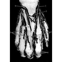 Рис. 1020. Ветви лучевого и локтевого нервов тыльной поверхности кисти, правой (фотография. Препарат В. Бобина). 1 – поверхностная ветвь лучевого нерва; 2 – соединительная ветвь между локтевым и лучевым нервами; 3 – тыльные пальцевые нервы (от лучевого нерва); 4 – концевые ветви от срединного нерва, переходящие на тыльную поверхность пальцев; 5 – тыльные пальцевые нервы (от локтевого нерва); 6 – тыльная ветвь локтевого нерва.