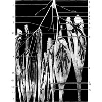 Рис. 1050. Распределение ветвей седалищного нерва (большеберцового и общего малоберцового нервов) в мышцах голени (фотография. Препарат С. Островского). I – икроножная мышца; II – камбаловидная мышца; III – длинный сгибатель пальцев; IV – задняя большеберцовая мышца; V – длинный сгибатель большого пальца стопы; VI – короткая малоберцовая мышца; VII – длинный разгибатель большого пальца стопы; VIII – длинный разгибатель пальцев; IX – передняя большеберцовая мышца; X – длинная малоберцовая мышца; XI – подошвенная мышца; 1 – седалищный нерв; 2 – медиальные кожные ветви голени; 3 – большеберцовый нерв; 4 – латеральный кожный нерв; 5 – икроножный нерв; 6, 8 – нервы камбаловидной мышцы; 7 – мышечная ветвь; 9 – большеберцовый нерв; 10 – общий малоберцовый нерв; 11 – нерв короткой головки двуглавой мышцы бедра.