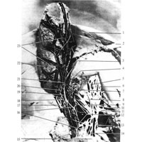 Рис. 1079. Печеночное сплетение и нервы желчного пузыря; вид спереди (фотография. Препарат И. Шапиро).