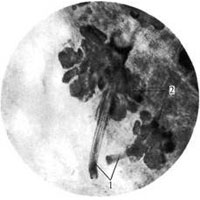 Рис. 1119. Сальные железы слезного мясца (фотография. Препарат В. Харитоновой). (Изолированные железы из тотально окрашенного препарата слезного мясца.)