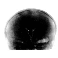Рис. 916. Желудочки мозга; рентгенограмма; затылочное положение. 1 – глазницы; 2 – лобные пазухи; 3 – III желудочек; 4 – правый боковой желудочек; 5 – левый боковой желудочек; 6 – IV желудочек.