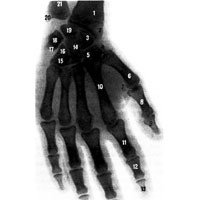 Рис. 257. Суставы кисти, правой (рентгенограмма). [Кисть в состоянии отведения (в сторону лучевой кости).] 1 – лучевая кость; 2 – шиловидный отросток лучевой кости; 3 – ладьевидная кость; 4 – кость-трапеция; 5 – трапециевидная кость; 6 – I пястная кость; 7 – сесамовидная кость; 8 – проксимальная фаланга большого пальца; 9 – дистальная фаланга большого пальца; 10 – II пястная кость; 11 – проксимальная фаланга указательного пальца; 12 – средняя фаланга указательного пальца; 13 – дистальная фаланга указательного пальца; 14 – головчатая кость; 15 – крючок крючковидной кости; 16 –крючковидная кость; 17 – трехгранная кость; 18 – гороховидная кость; 19 – полулунная кость; 20 – шиловидный отросток локтевой кости; 21 – локтевая кость.