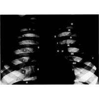 Рис. 699. Грудная клетка — сердце и легкие взрослого человека (рентгенограмма). 1 - 5 — передние отделы ребер; 6 - левый желудочек; 7 - правое предсердие; 8 - реберно-медиастинальный синус; 9 - нисходящая часть аорты; 10 - дуга аорты; 11 - верхняя полая вена и восходящая часть аорты; 12 - правый купол диафрагмы; 13 - легочный ствол; 14 - тень корня легкого; 15 - легочный рисунок; III - VIII — ребра, задние отделы.